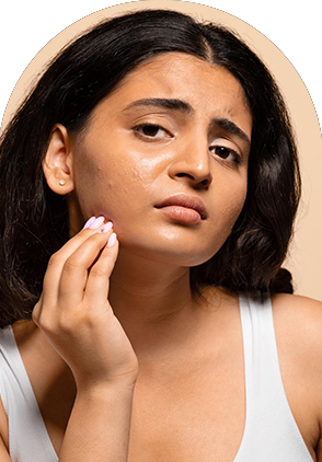 Acne Control